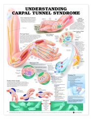 Understanding Carpel Tunnel Syndrome